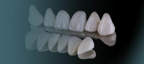 Эстетическая реставрация зубов винирами